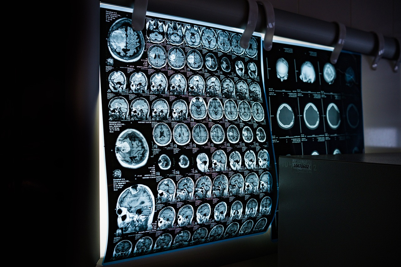 Novo teste é capaz de diagnosticar o Parkinson precocemente - TecMundo